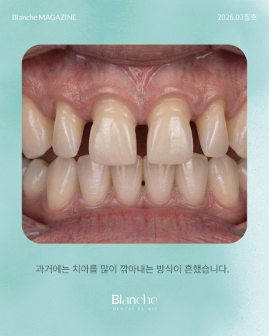 옛날에 한 라미네이트, 요즘 자꾸 신경 쓰인다면? 관련 이미지 8