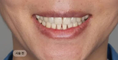 5 Criteria to Review Before Deciding on Minimal-Preparation Veneers image 6