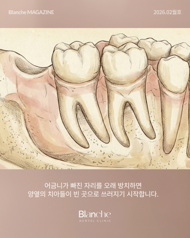 어금니 뺀 자리, 당장 안 아픈데 꼭 임플란트 해야 할까? 관련 이미지 7