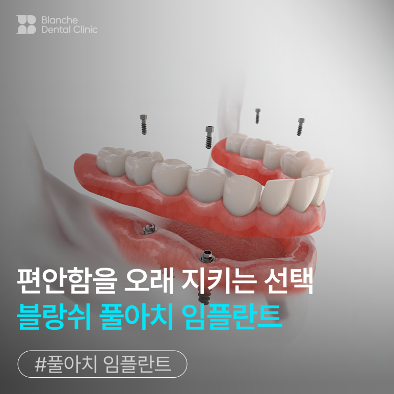 풀아치 임플란트 대상, 치료 시기와 기준을 알려드립니다 관련 이미지 1