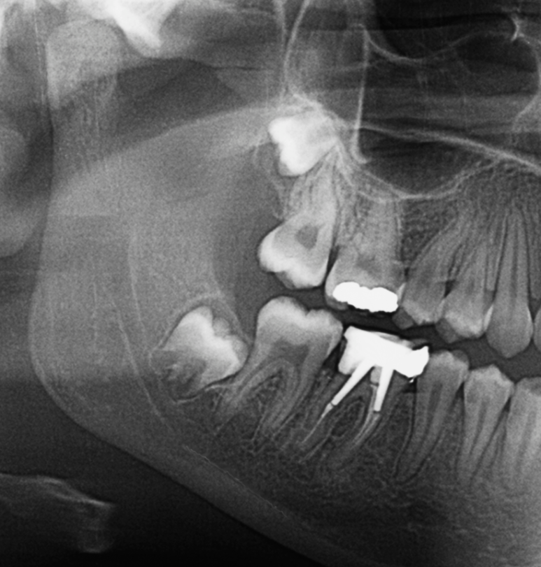 Impacted Wisdom Teeth: The Difference Between When a Dentist Says to Remove Them and When to Monitor Them image 2