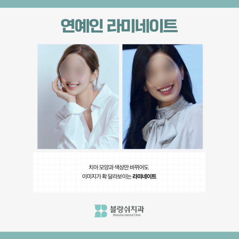 라미네이트 수명 10년? 오해와 진실 관련 이미지 2