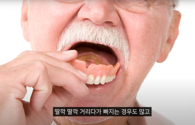 Digital Full-Arch Implants: How Are They Different from Dentures? image 2