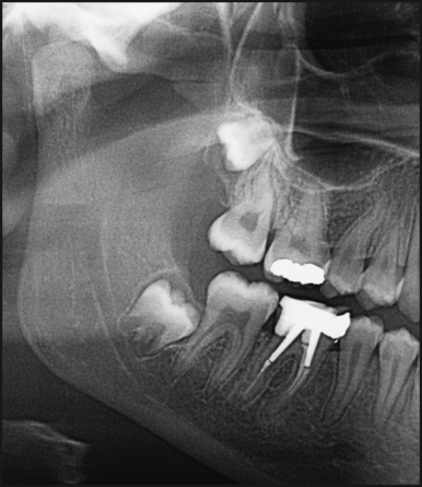 사랑니 발치 통증 붓기 언제까지?블랑쉬에서 알려드림 관련 이미지 8