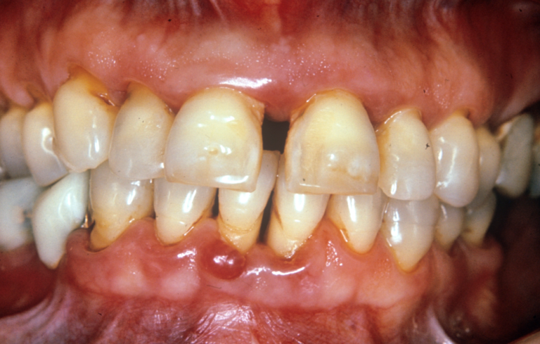 Black Triangles: Causes and Prevention to Know Before Resin Treatment image 5