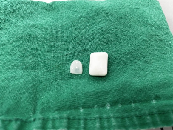 무삭제라미네이트비용? 체크사항 2가지 알려드립니다 관련 이미지 8