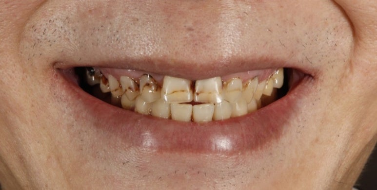 치아미백 시술? 블랑쉬? 어떤 것이 좋을지 고민된다면 관련 이미지 6