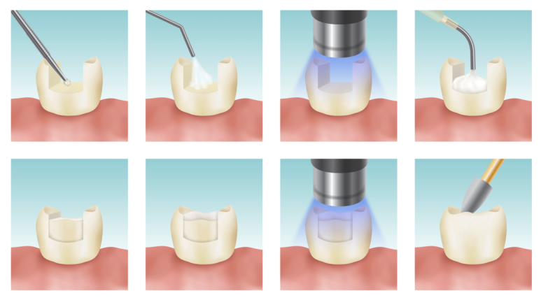 Composite Resin vs. Inlay: Differences in Price, Lifespan & Insurance Coverage | A Dentist’s Guide to Choosing Cavity Treatment image 2