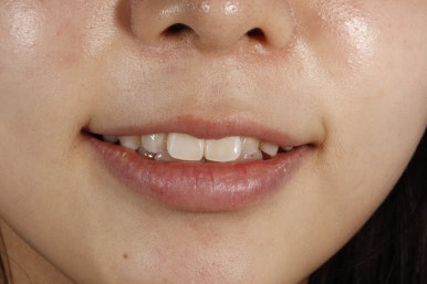 무삭제 라미네이트 비용, 이것만은 꼭 확인했어야 했어요 관련 이미지 4