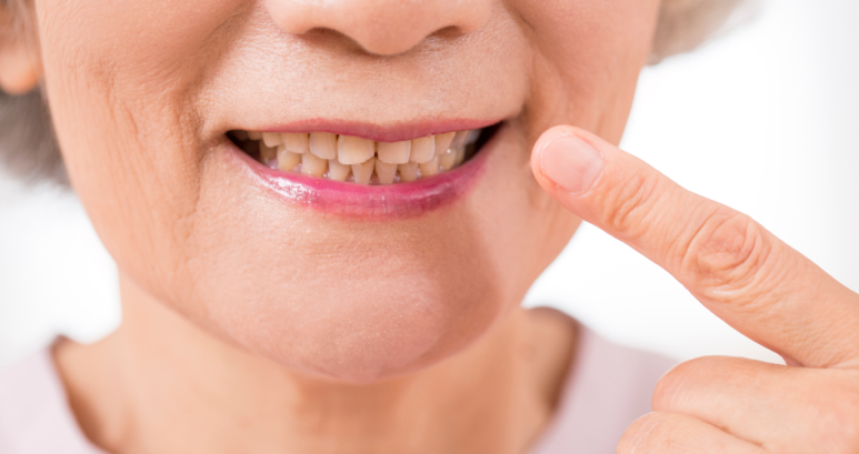 5 Causes of Yellow Teeth and DiscolorationㅣWhy Brushing Alone Doesn’t Work, Explained by a Dentist image 5