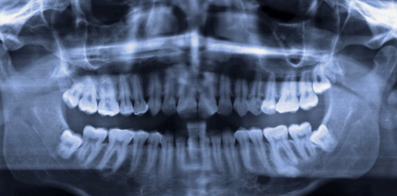 부분임플란트, 하나만 심으면 되는데 왜 비용 차이가 3배까지 날까? 관련 이미지 10
