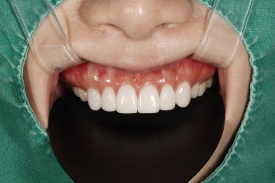 치아미백 라미네이트, 그리고 무삭제 라미네이트의 차이는? 관련 이미지 19