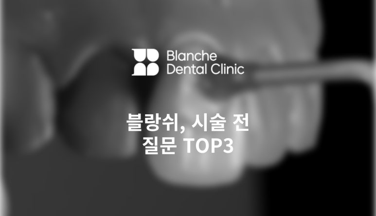 [블랑쉬치과]완전 하얀 라미네이트, 블랑쉬 시술 전 질문 TOP5 관련 이미지 1