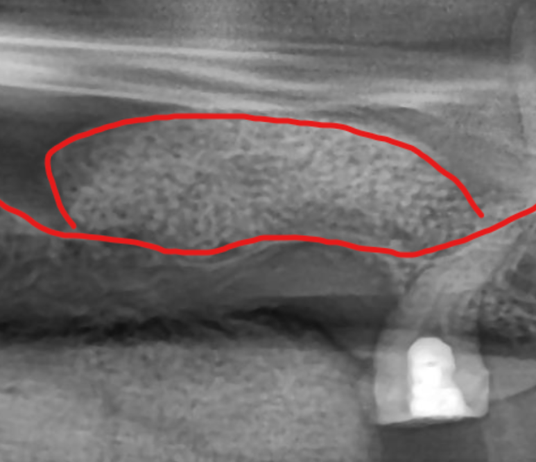 어금니 임플란트 뼈이식 통증 비용 총정리 관련 이미지 7