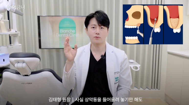 어금니 임플란트 뼈이식 통증 비용 총정리 관련 이미지 5