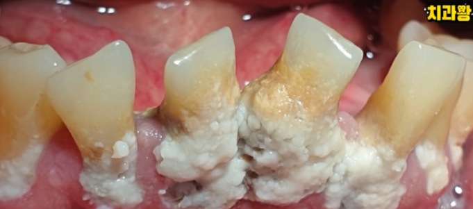 잇몸 부었을 때, 절대로 방치하면 안되는 증상 3가지 관련 이미지 10