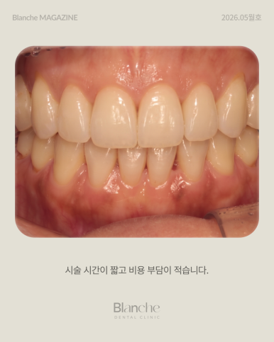Black Gaps Between Teeth After Orthodontic Treatment image 7