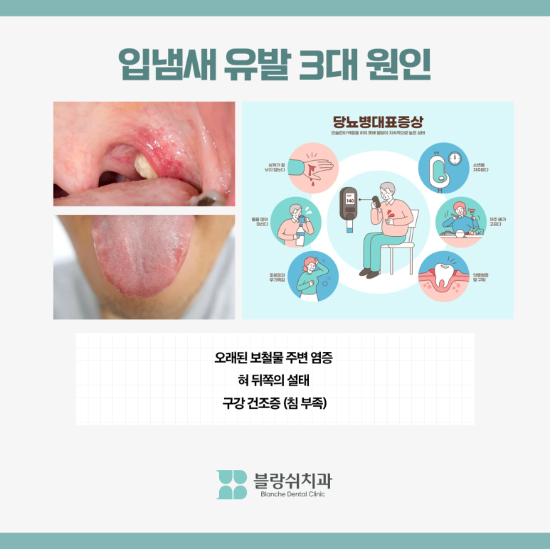 입냄새 심한 이유 구취 원인 입냄새 해결 방법 관련 이미지 2