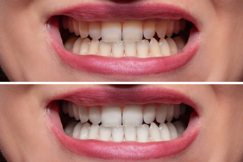 5 Causes of Yellow Teeth and DiscolorationㅣWhy Brushing Alone Doesn’t Work, Explained by a Dentist image 7