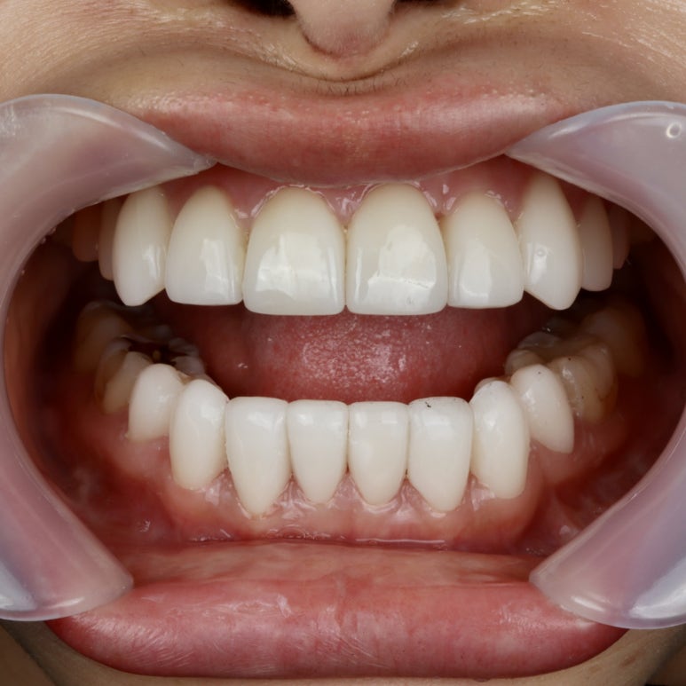 Black Triangles: Causes and Prevention to Know Before Resin Treatment image 6