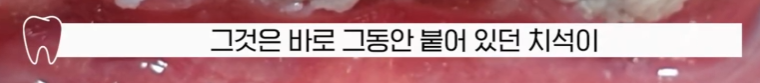 (피나는)잇몸 스케일링 방치하면 위험한 이유 관련 이미지 9