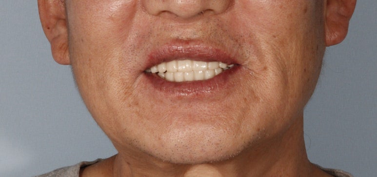 풀아치 임플란트 후기만 믿고 결정하기 전에 꼭 보세요 관련 이미지 1