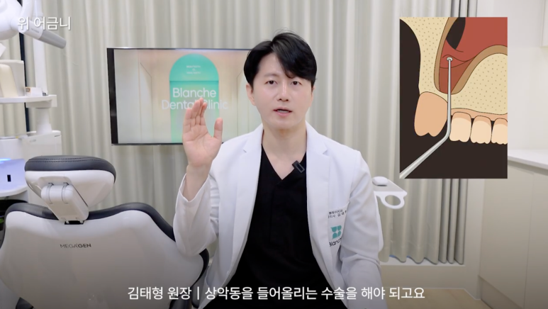 어금니 임플란트 뼈이식 통증 비용 총정리 관련 이미지 3