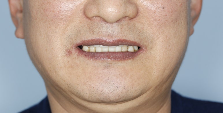 풀아치 임플란트 후기만 믿고 결정하기 전에 꼭 보세요 관련 이미지 11