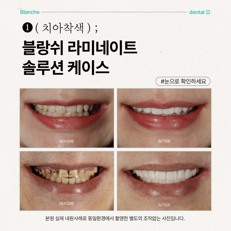 블랑쉬 라미네이트 솔루션 사례 (치아착색개선) 관련 이미지 6