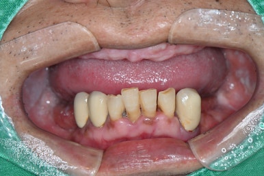 강남 풀아치 임플란트 치과, 4개로 틀니를 대체한다? 관련 이미지 5