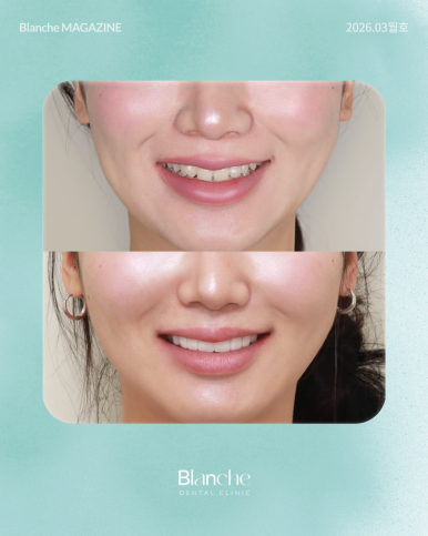 라미네이트 후 관련 이미지 11