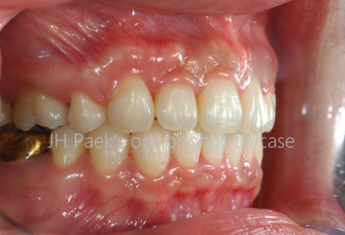 라미네이트부작용을 막는 3가지 비밀 - 대표원장 작성 관련 이미지 6