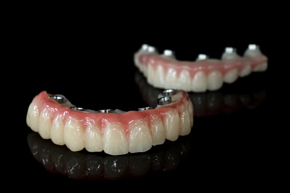 전체임플란트 가격? 전부 심지 않아도 되는 방법이 있습니다. 관련 이미지 6