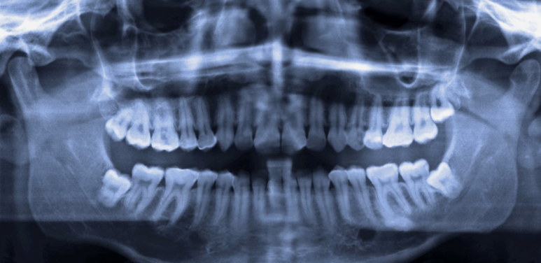 Impacted Wisdom Teeth: The Difference Between When a Dentist Says to Remove Them and When to Monitor Them image 4