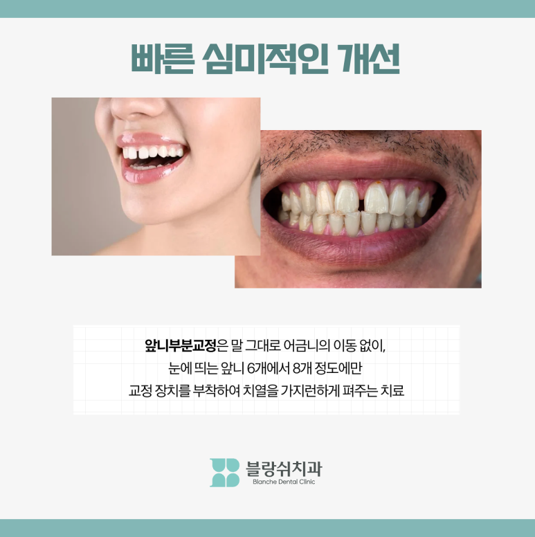 반포치과 앞니 부분교정 고려중이라면 필독 관련 이미지 2