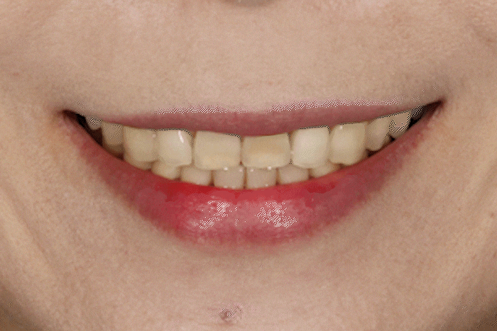 무삭제 라미네이트 추천, 어떤 케이스에 적합할까요? 관련 이미지 7