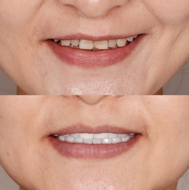 무삭제 라미네이트 가격 비교? 이 글로 정리해드립니다. 관련 이미지 1