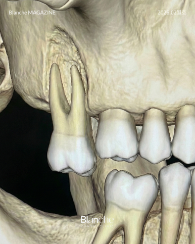 어금니 뺀 자리, 당장 안 아픈데 꼭 임플란트 해야 할까? 관련 이미지 9