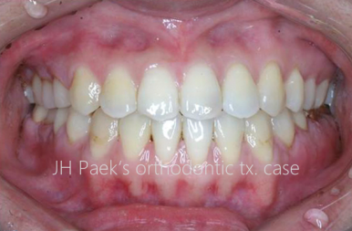 반포치과 앞니 부분교정 고려중이라면 필독 관련 이미지 4
