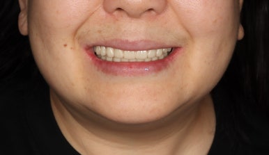 풀아치 임플란트 치과? 임플란트 결정 전 꼭 읽어보세요. 관련 이미지 10