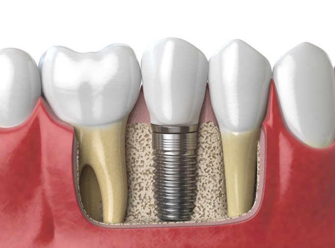 The Differences Between Implant Types: How a Dentist Who Has Placed 30,000 Implants Really Chooses a Brand image 2