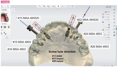 강남 풀아치 임플란트 치과, 4개로 틀니를 대체한다? 관련 이미지 9