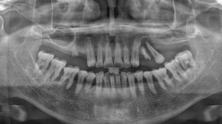 학동역 임플란트 재수술 한 번 실패했는데 다시 해도 괜찮을까 걱정된다면 관련 이미지 6