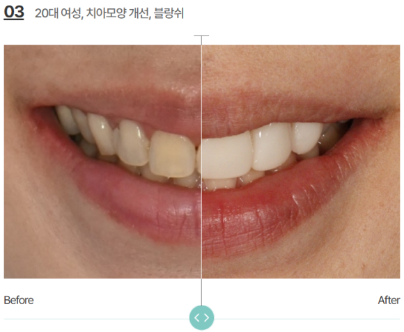 무삭제라미네이트가격, 손끝에서 결정됩니다. 관련 이미지 8