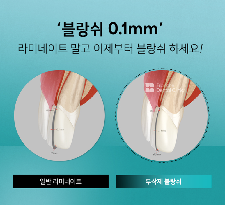 이제 라미네이트 말고 관련 이미지 7