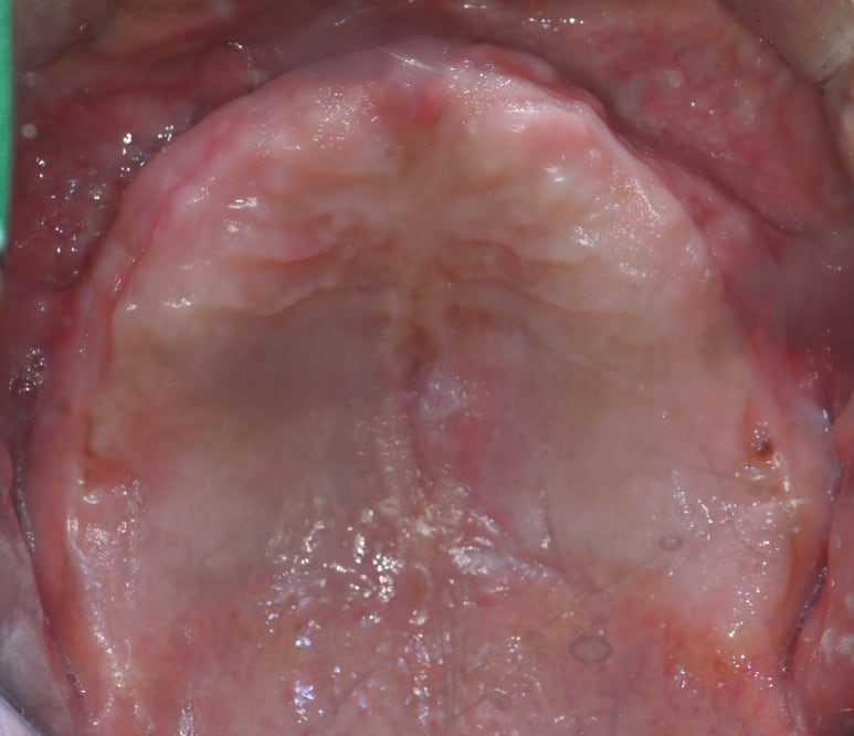 강남 풀아치 임플란트 치과, 4개로 틀니를 대체한다? 관련 이미지 4