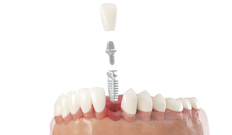 Implants, Learn Them Properly First ① Four Types of Implants, and There Are Specific Brands That Dentists Place Themselves image 4