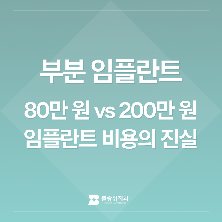 부분임플란트, 하나만 심으면 되는데 왜 비용 차이가 3배까지 날까? 관련 이미지 1