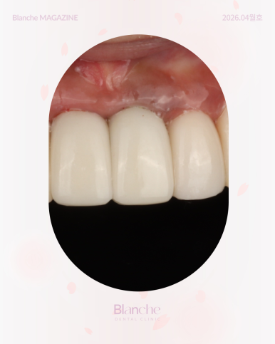 잇몸이 까맣게 변했어요! 원인별 맞춤 해결법 관련 이미지 3