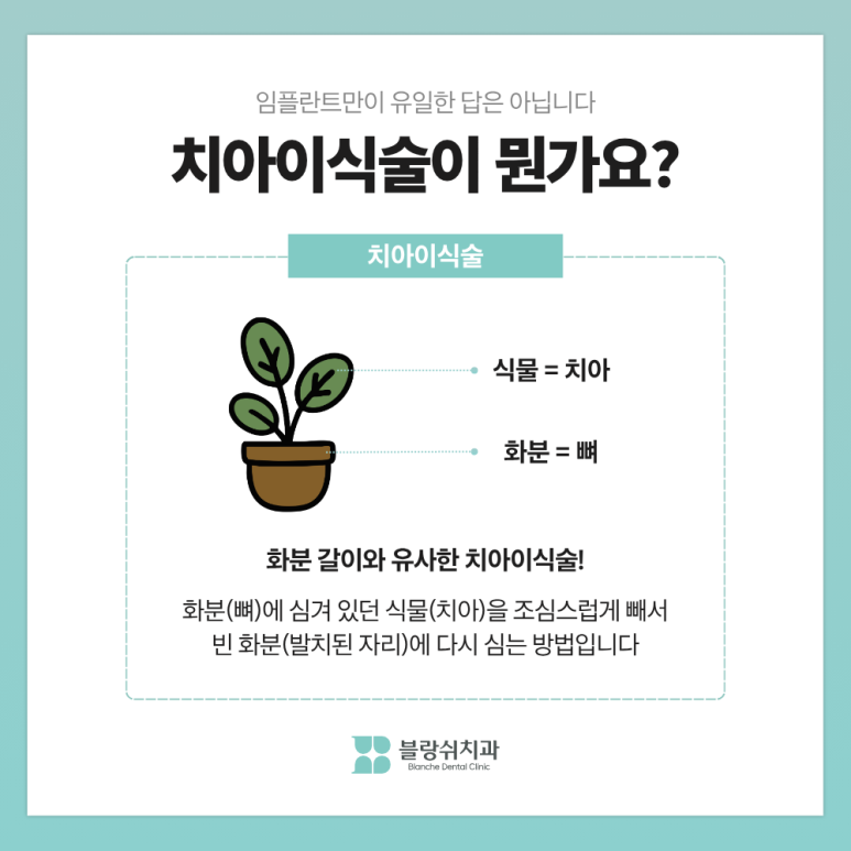 치아이식술 성공률 높이는 핵심 조건 3가지, 임플란트 전에 꼭 읽어보세요 관련 이미지 2